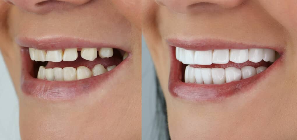 Smile Makeover
