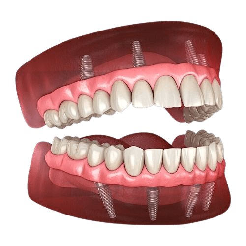 Full Mouth Rehabilitation