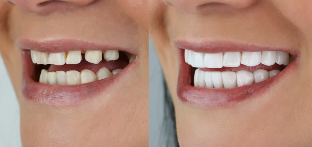Smile Makeover