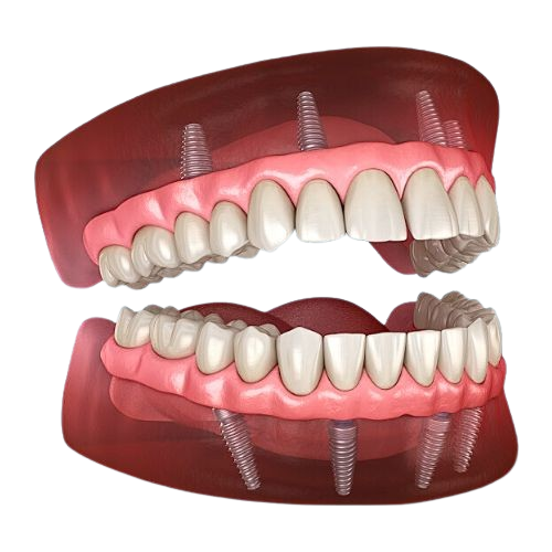 Full Mouth Rehabilitation