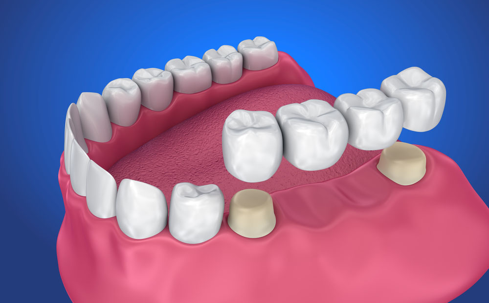 Dental Crowns & Bridges